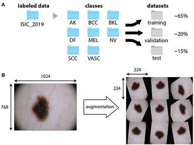 Convolutional Neural Network for Skin Lesion Classification: Understanding the Fundamentals Through Hands-On Learning